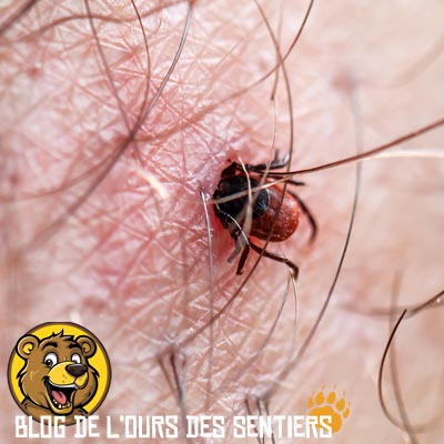 La piqure de tique n'est généralement pas douloureuse, mais pas sans risques à cause de la borréliose maladie de lyme très grave